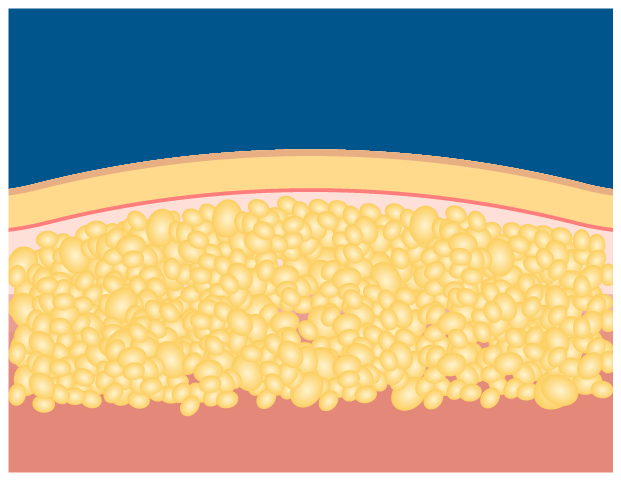 クライオリポライシスのイメージ図