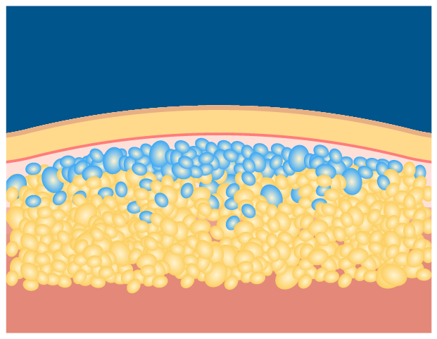 クライオリポライシスのイメージ図