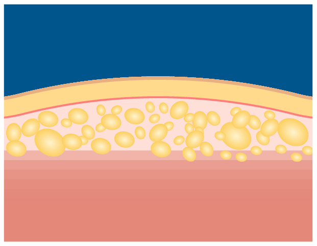 クライオリポライシスのイメージ図